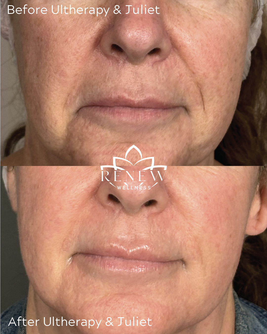Ultherapy and Juliet before and after showing a smoother, firmer-looking lower face and neck