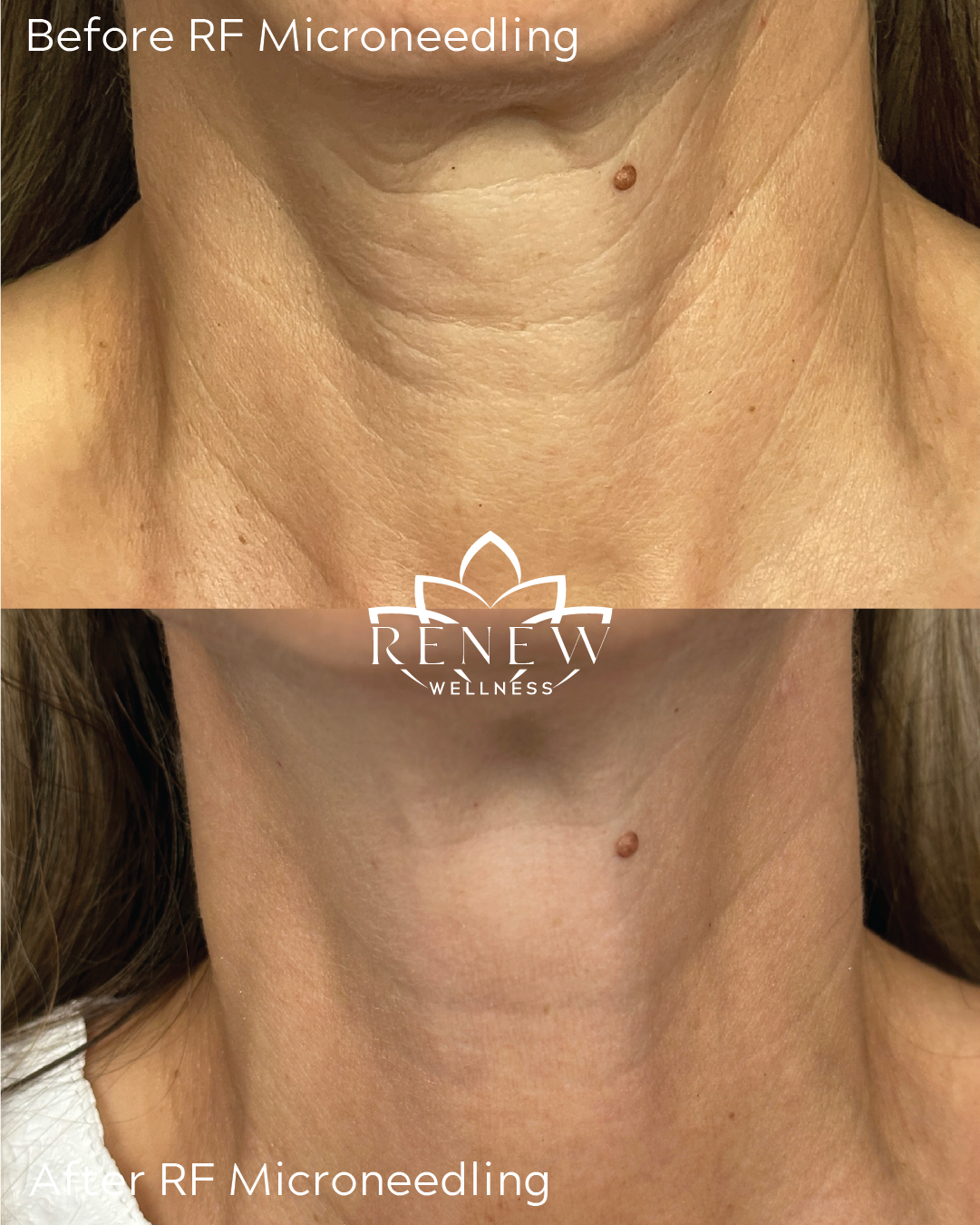 RF microneedling before and after showing a smoother, firmer-looking neck