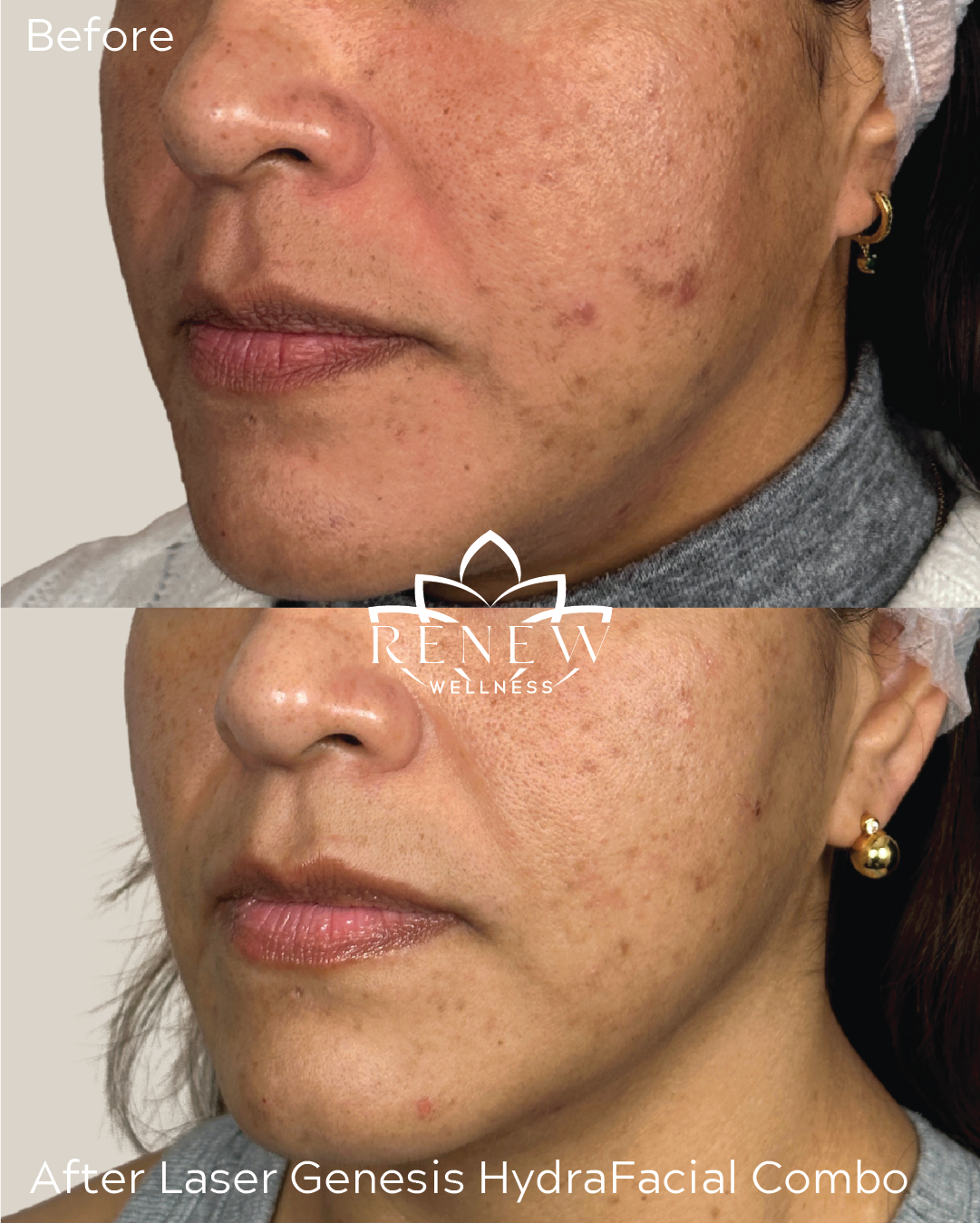 Laser Genesis and HydraFacial before and after showing clearer, smoother-looking skin