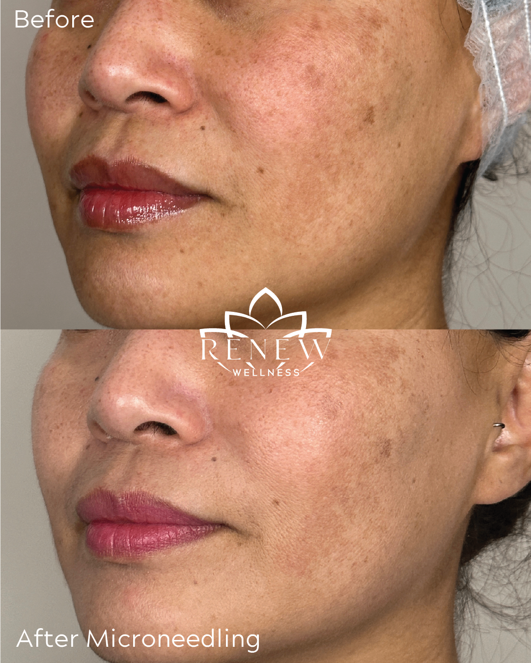 Microneedling before and after with reduced pigmentation around the cheek