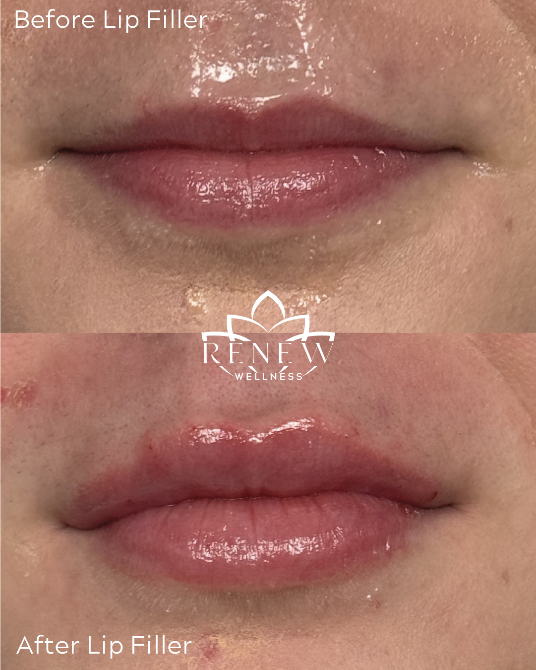Lip filler before and after result 8 showing fuller, more defined lips