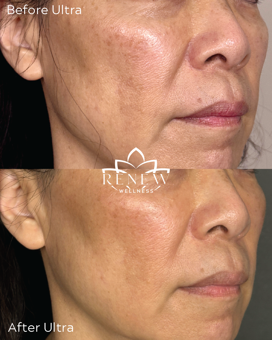LaseMD Ultra before and after showing improvement across the cheek, jawline, and neck
