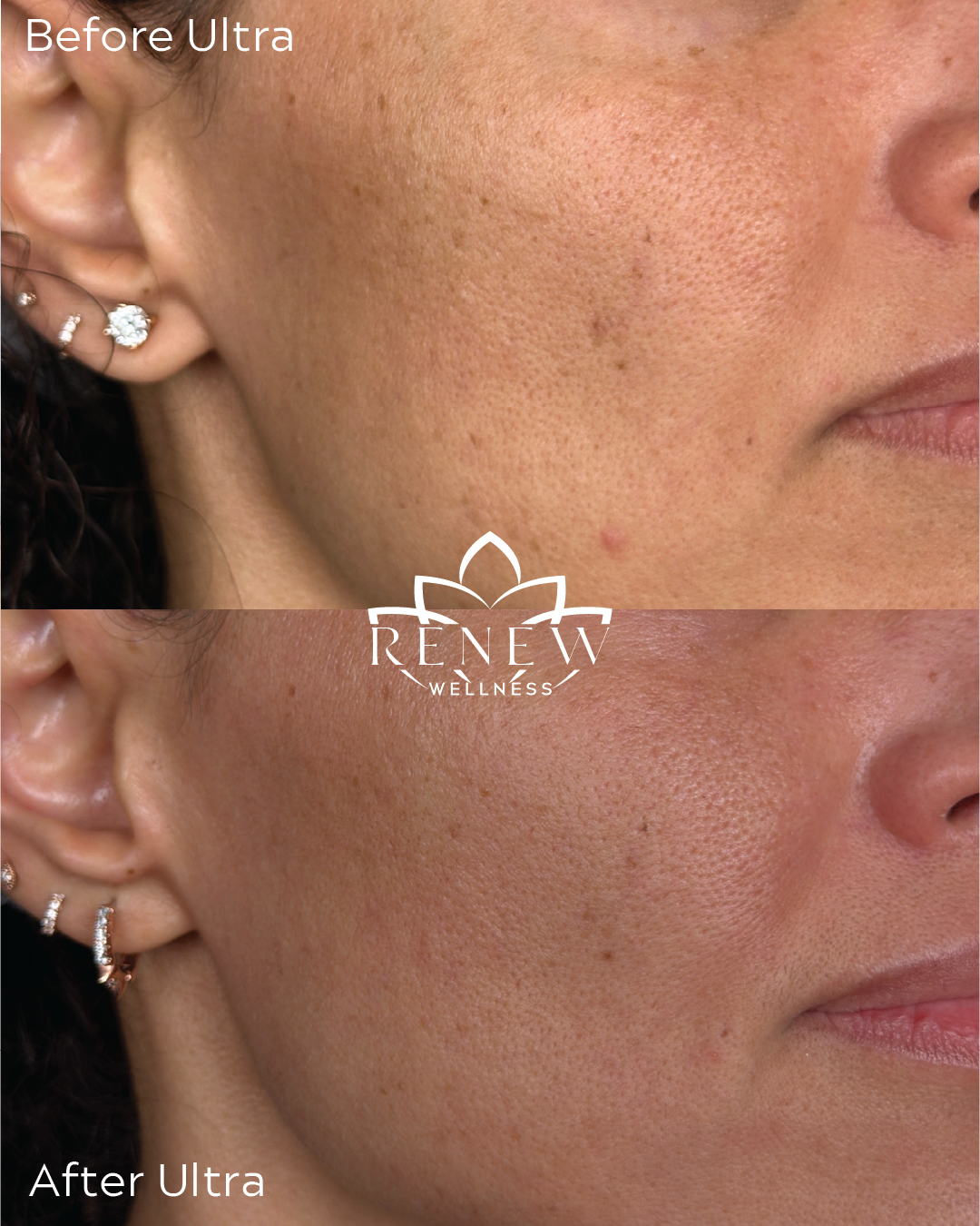 LaseMD Ultra before and after showing smoother, brighter cheek skin texture