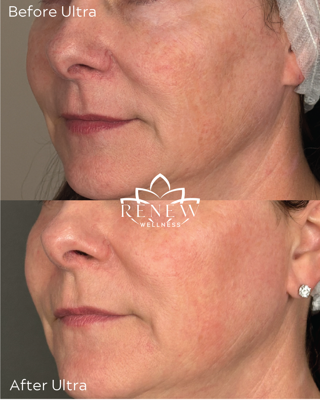 LaseMD Ultra before and after showing a more even tone along the lower face and neck