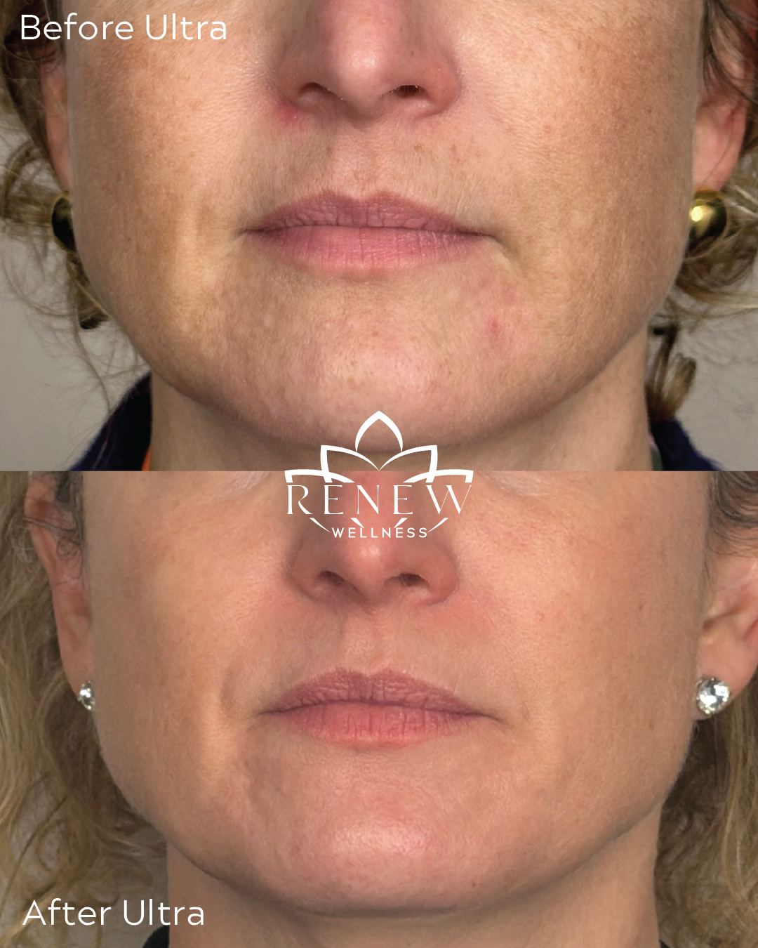 LaseMD Ultra before and after showing smoother skin and improved tone along the lower face and neck