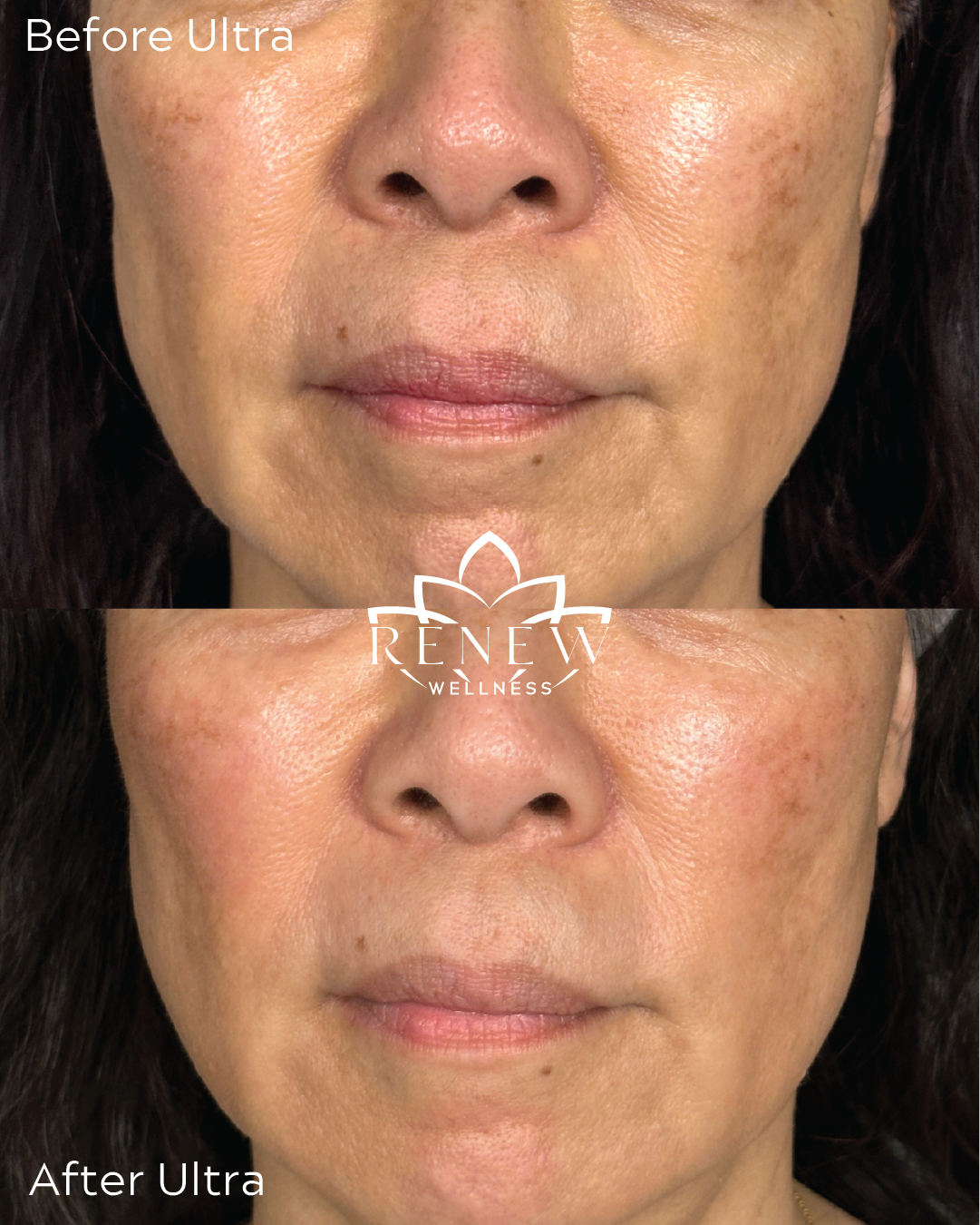 LaseMD Ultra before and after showing more even tone through the mid-face and lower face