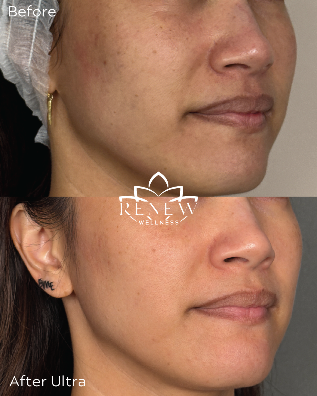 LaseMD Ultra before and after showing smoother, clearer skin along the cheek and jawline