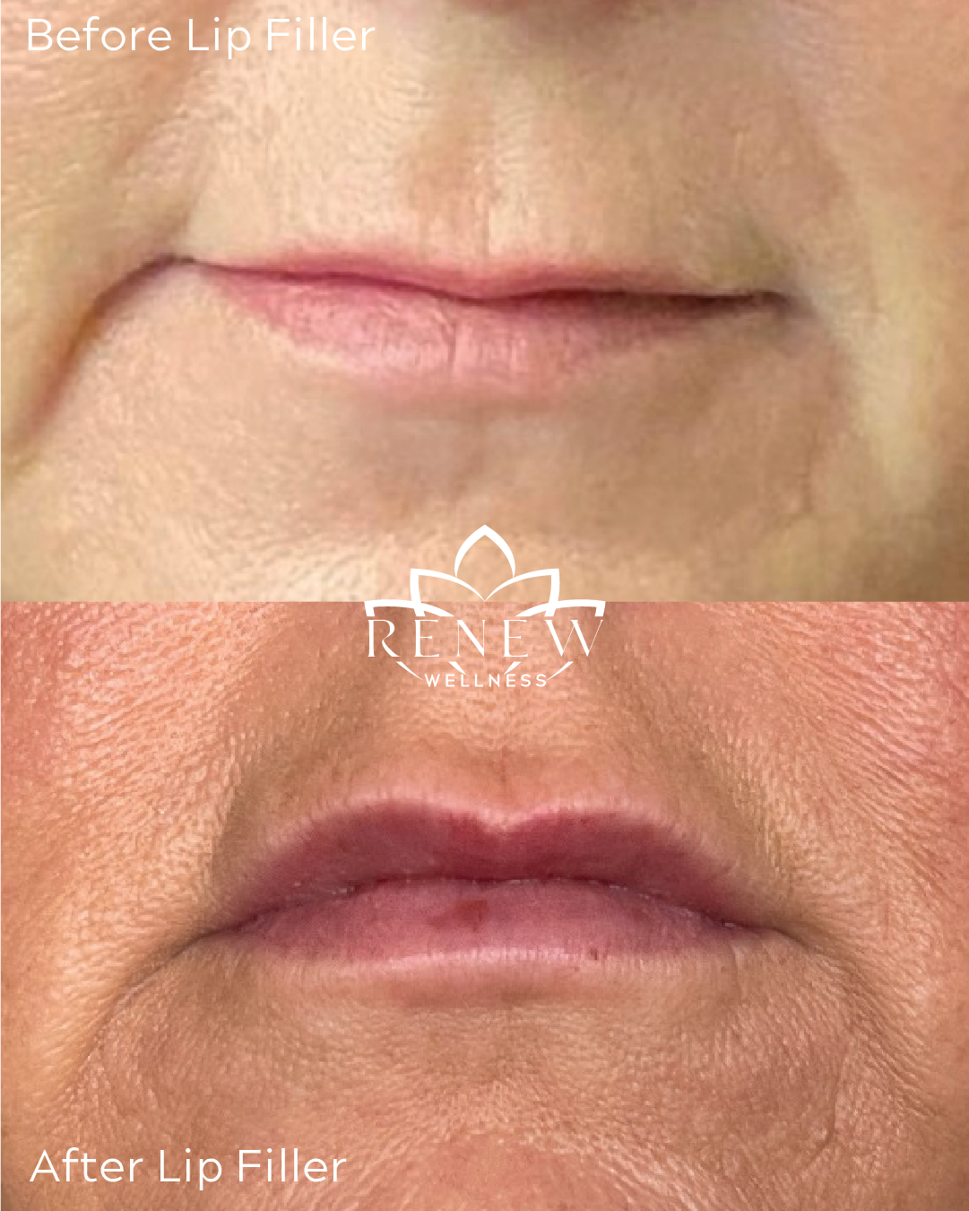 Lip filler before and after result 3 showing fuller, more defined lips