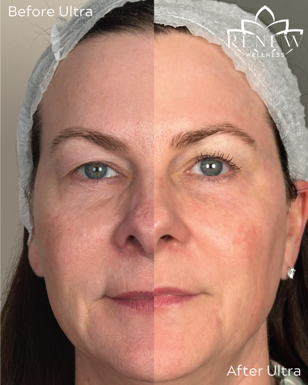 LaseMD Ultra before and after showing brighter, more even-looking skin