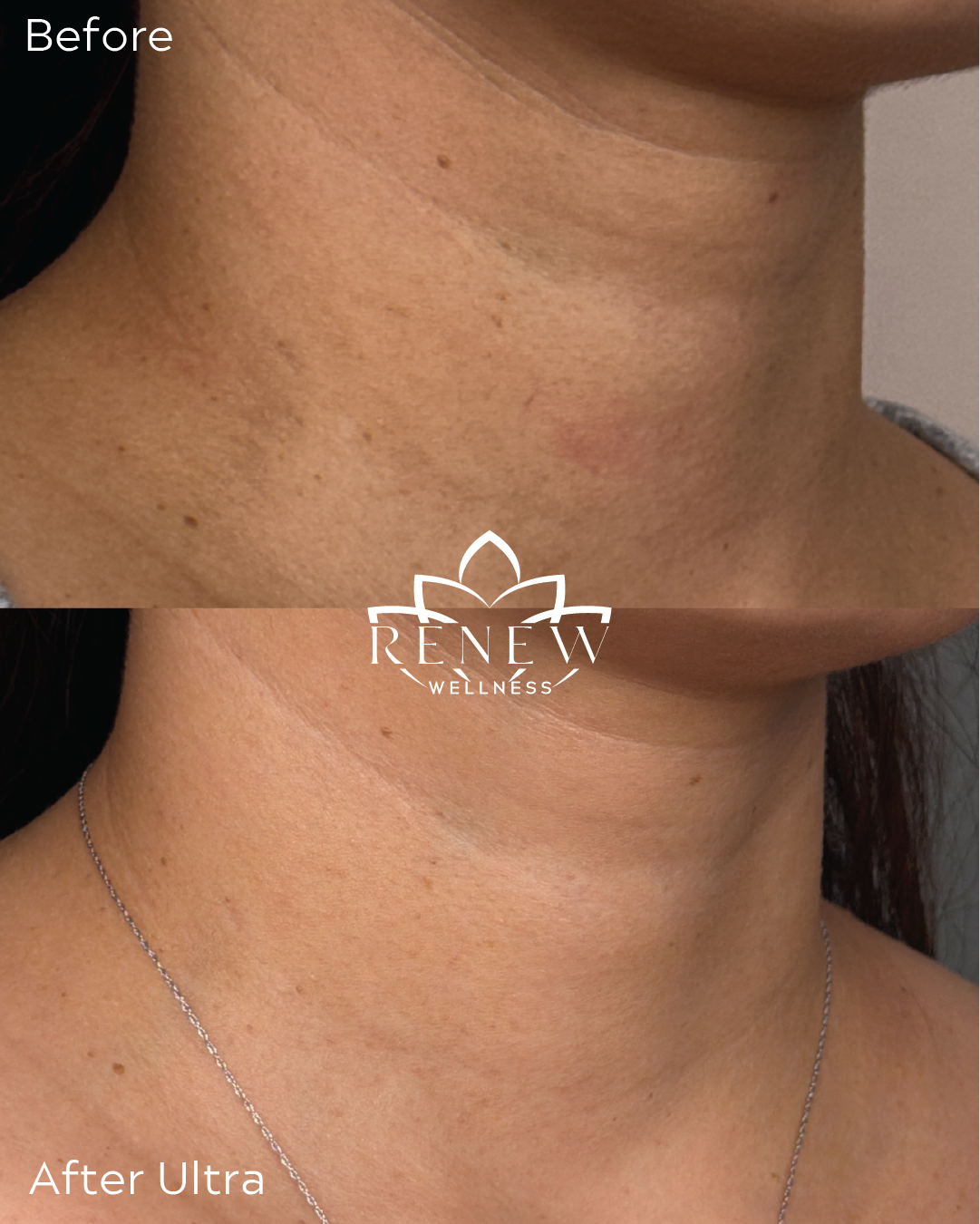 LaseMD Ultra before and after showing improved neck tone and texture
